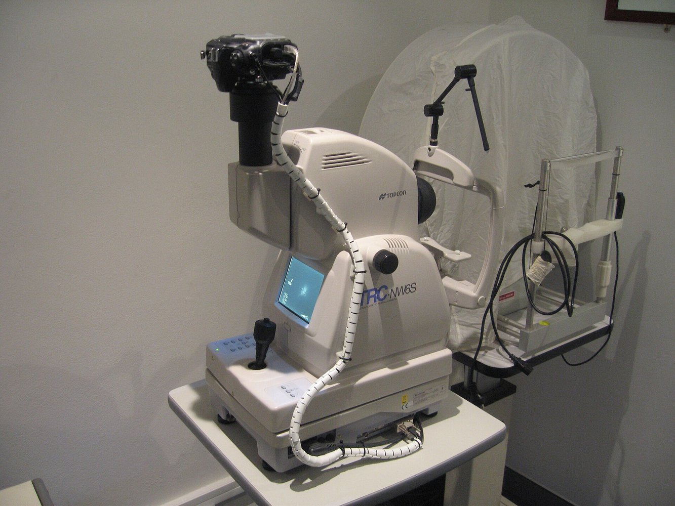Retinal changes linked to later atrial fibrillation diagnosis